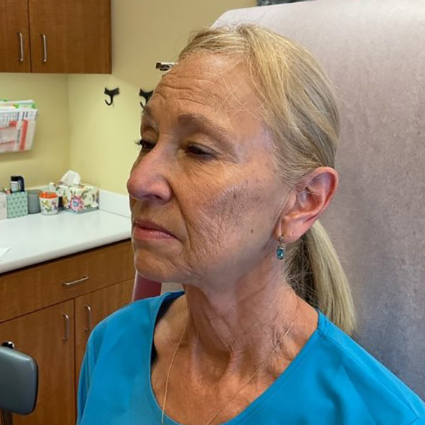 Before and After Lower Face and Neck Lift Washington DC 2