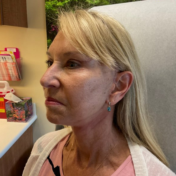 Before and After Lower Face and Neck Lift Washington DC 4