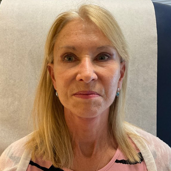 Before and After Lower Face and Neck Lift Washington DC 3