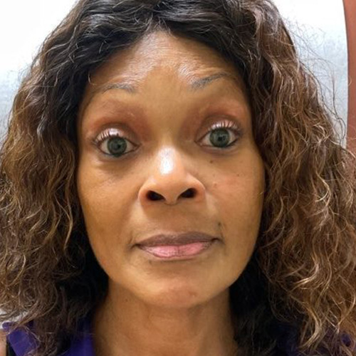 Before and After Injectables - Washington DC 2a