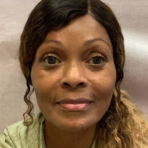 Before and After Injectables - Washington DC 2b